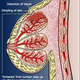 Image for article titled Report: Breast Cancer Risk Drops After Stopping Hormone Therapy